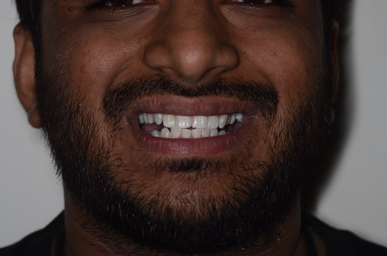 After treatment