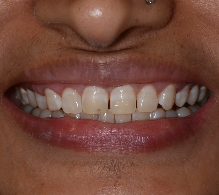 Before treatment