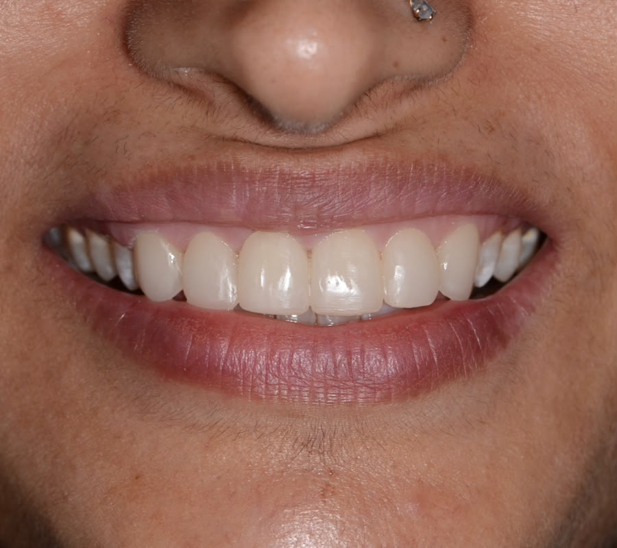 After treatment