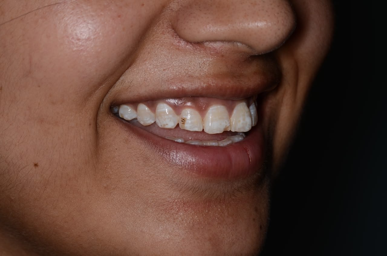Before treatment