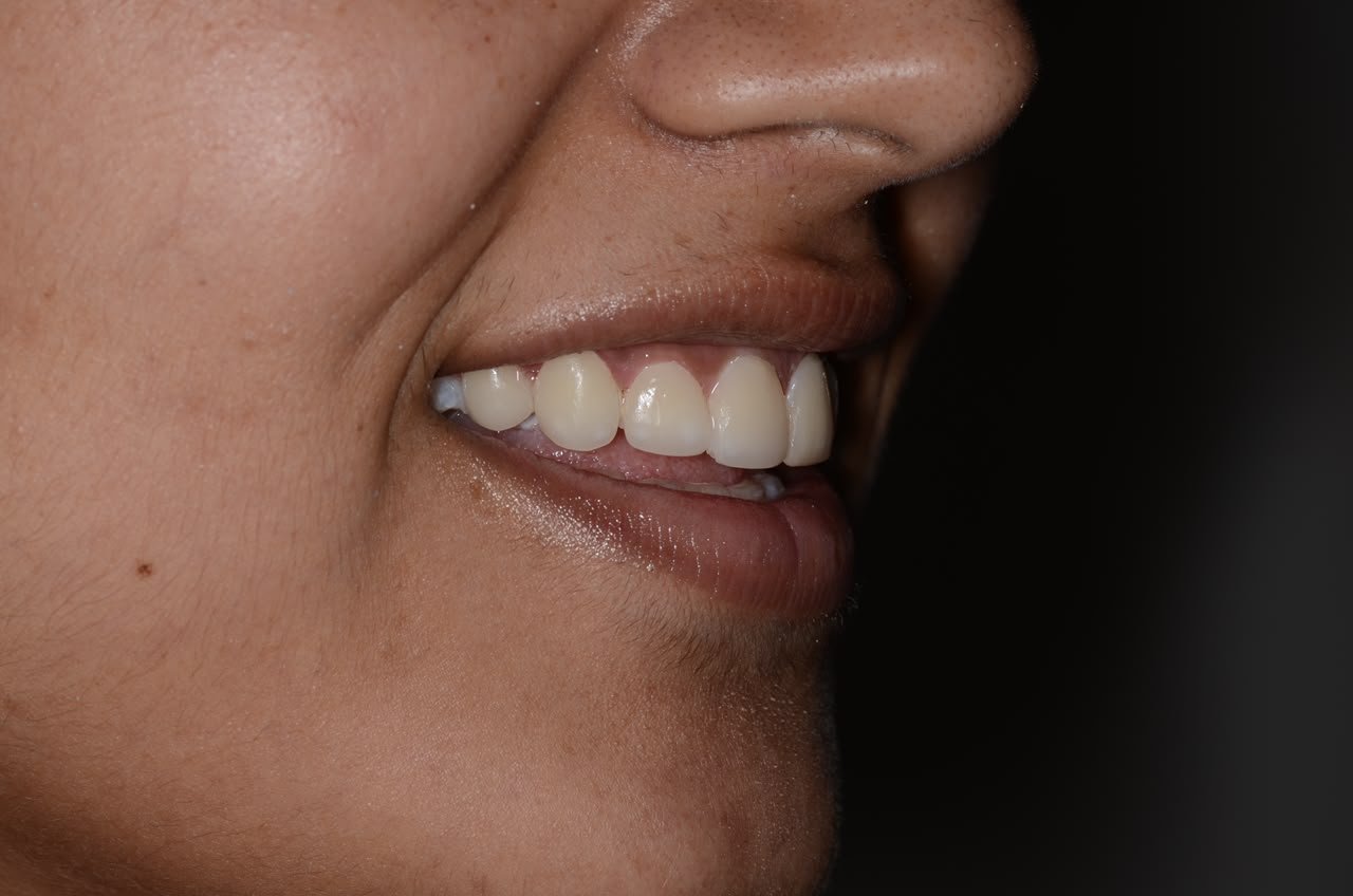 After treatment