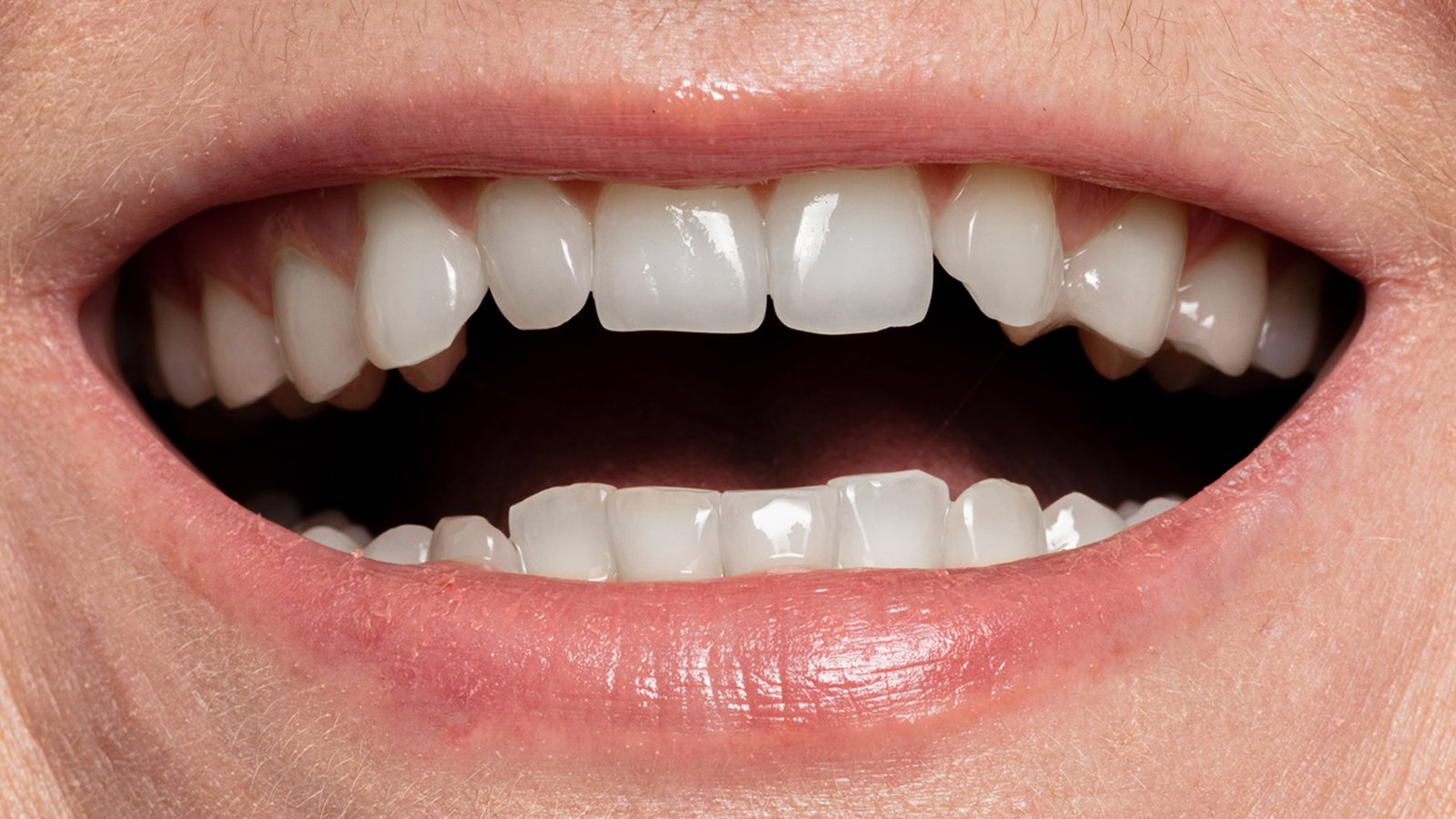 teeth-after